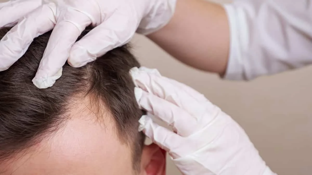 Alopecia Androgenética Masculina – Diagnóstico e Tratamento